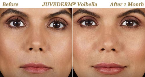 Before After Photos Juvederm Volbella Minneapolis MN