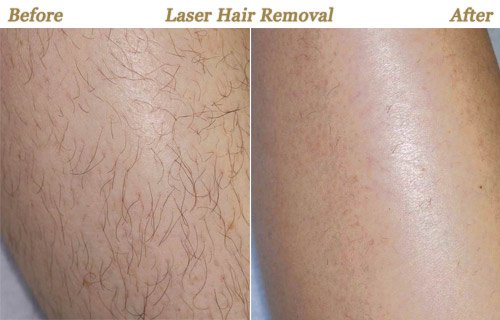 laser back hair removal cost